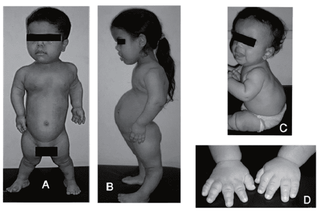Skeletal dysplasia baby